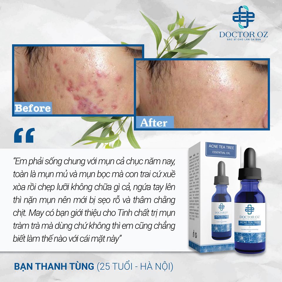 Serum Ngăn Ngừa Mụn Chiết Xuất Từ Tràm  DOCTOR OZ ( 5ml) Tặng kèm Mặt Nạ Ngủ Môi Chống Thâm Và Khô Nứt Môi