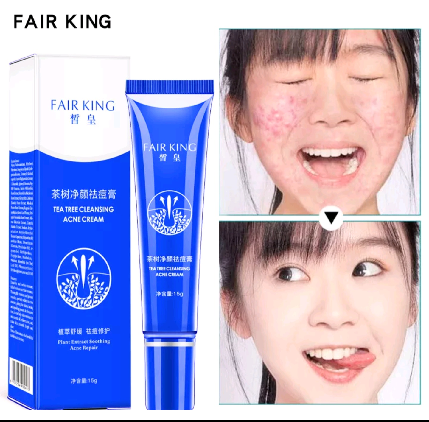 KEM LOẠI BỎ CHỐNG MỤN LÀM TRẮNG DA MẶT LÀM SẠCH SÂU DA MẶT