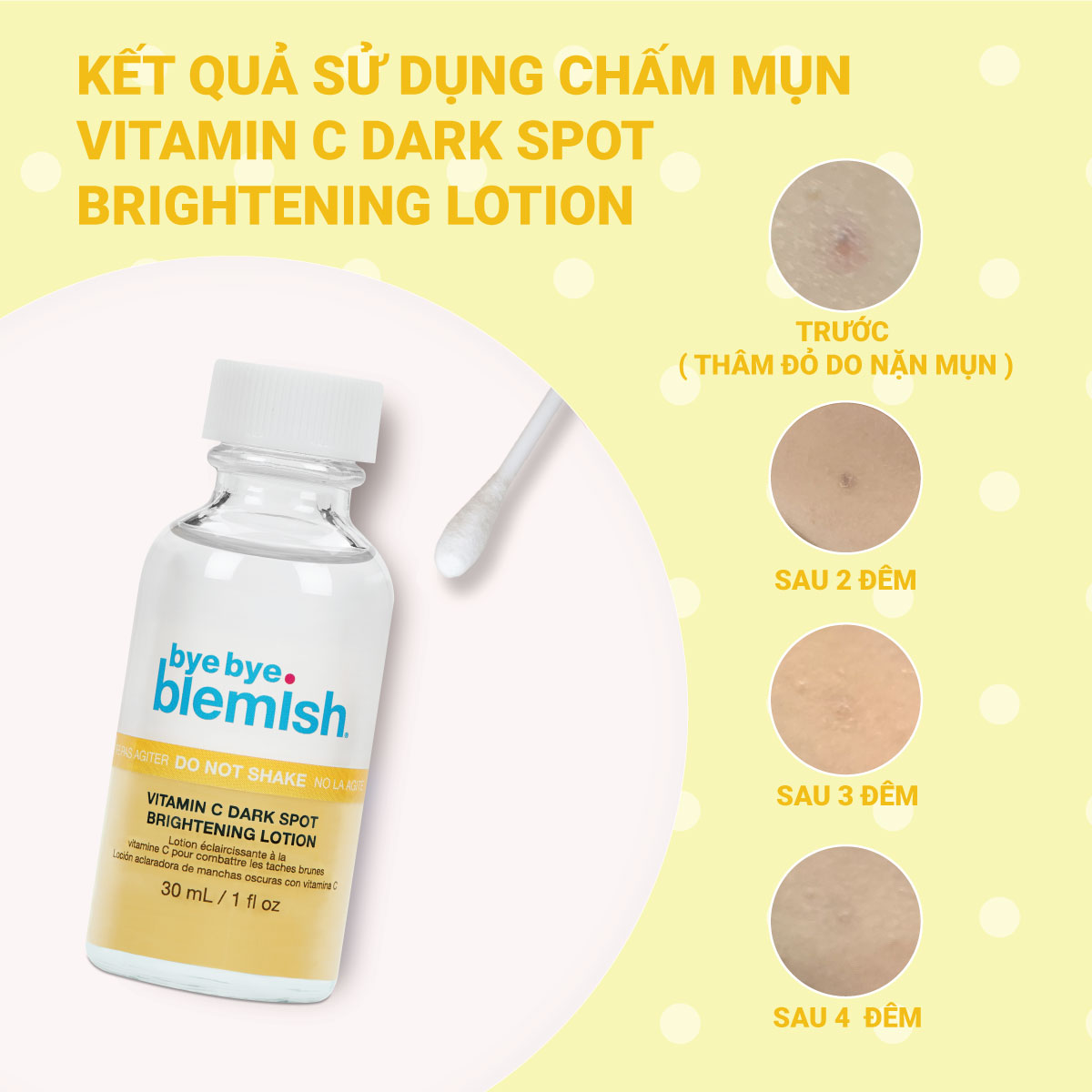 Chấm mụn Vitamin C giảm mụn nhanh sau 1 đêm cho da mụn thâm xỉn màu Bye Bye Blemish Vitamin C Dark Spot Brightening Lotion 30ml