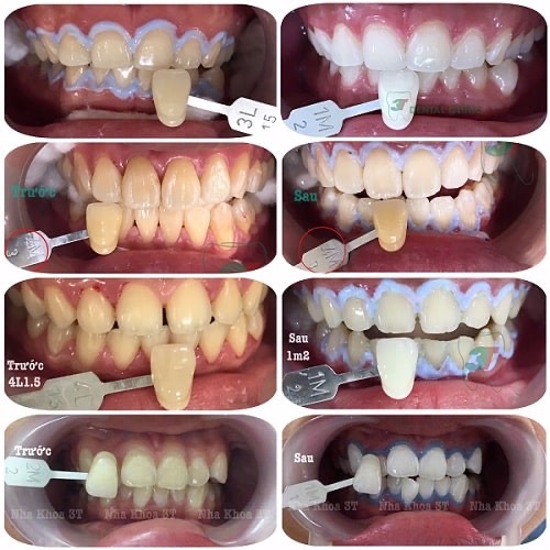 Nha Khoa Nhật Nguyệt SG - Tẩy Trắng Răng 