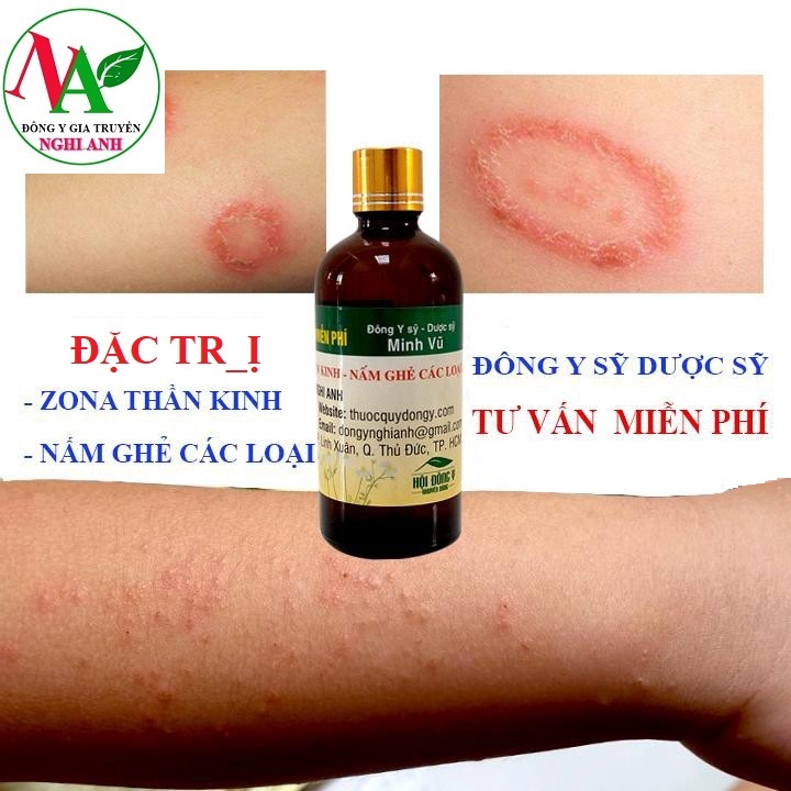 Thuốc Bôi Đặc Trị Zona Thần Kinh, Nấm Ghẻ, Ngứa Dị Ứng Hiệu Quả Đông Y Nghi Anh Lọ 100ml