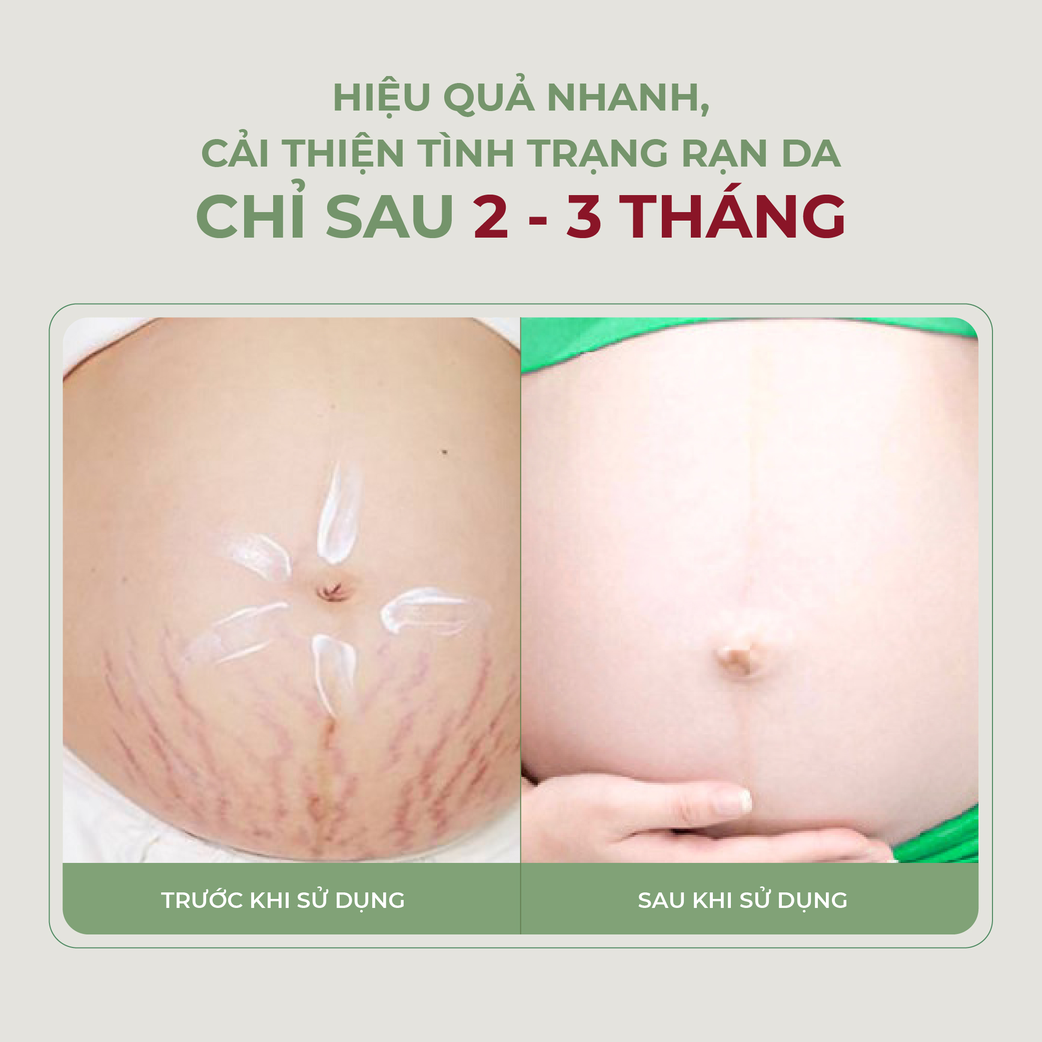 [Combo 2] Kem Rạn Da OVELA ABERA 50ML, Dưỡng Ẩm,  Giảm Rạn Cũ, Ngừa Rạn Mới, Mờ Thâm Bụng, Xóa Tan Mọi Âu Lo Về Rạn Da