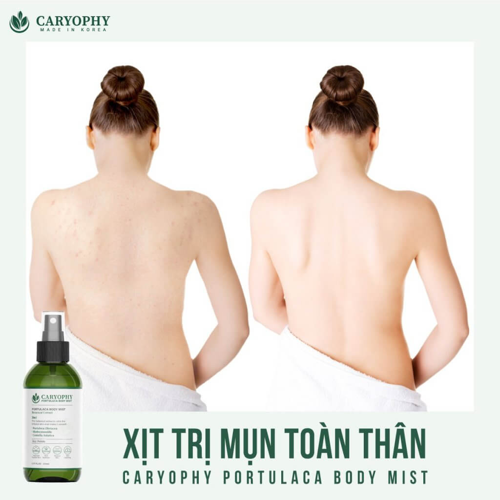 Xịt giảm mụn, giảm thâm mụn lưng, mụn toàn thân Caryophy Portulaca Body Mist 150ml + Tặng Kèm 1 Băng Đô Tai Mèo (Màu Ngẫu Nhiên)