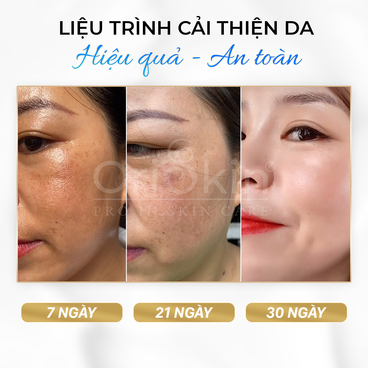 Kem Dưỡng Trắng Da Mờ Nám Tàn Nhang Melasma White Perfect Cream, Giảm Thâm Sạm Sau Mụn, Phù Hợp Với Cả Da Nam Và Nữ