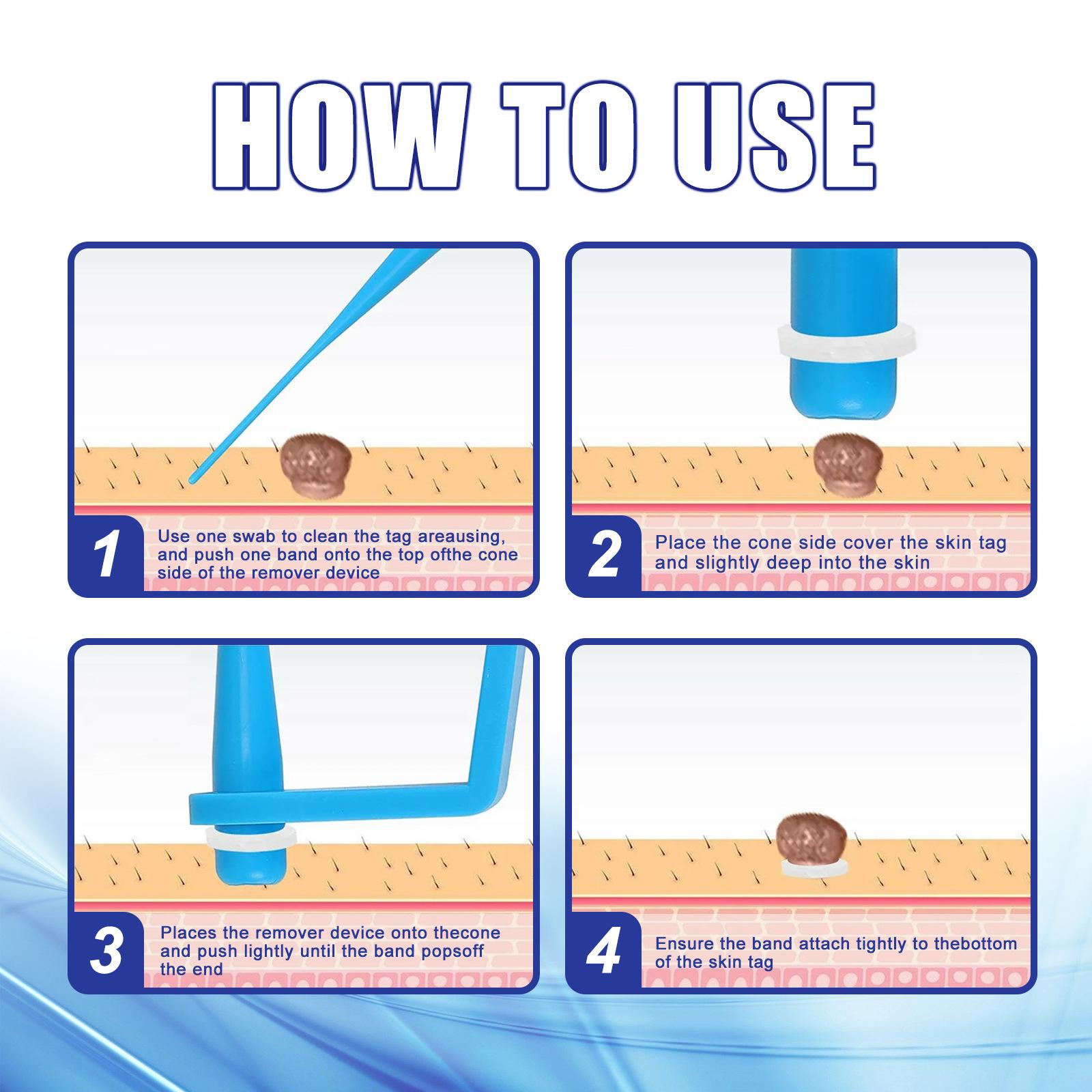 South Moon 30pcs/Box Mole Wart Remover Skin Tag Rubber Band Soften Keratin Painless Removal