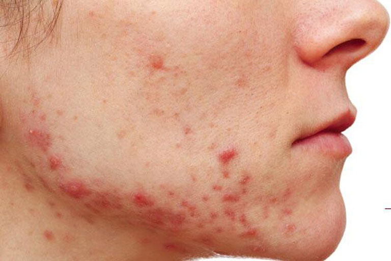 Thảo dược bôi nấm ngứa, tổ đỉa, hắc lào, lang ben, vảy nến, á sừng, zona các vấn đề về da_1 hộp 20 gói