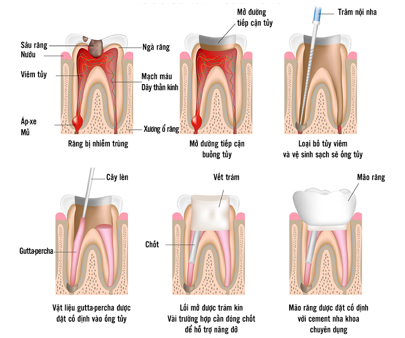 Điều trị nội nha - Viêm tủy - viêm nướu tại Nha Khoa Gia Hân