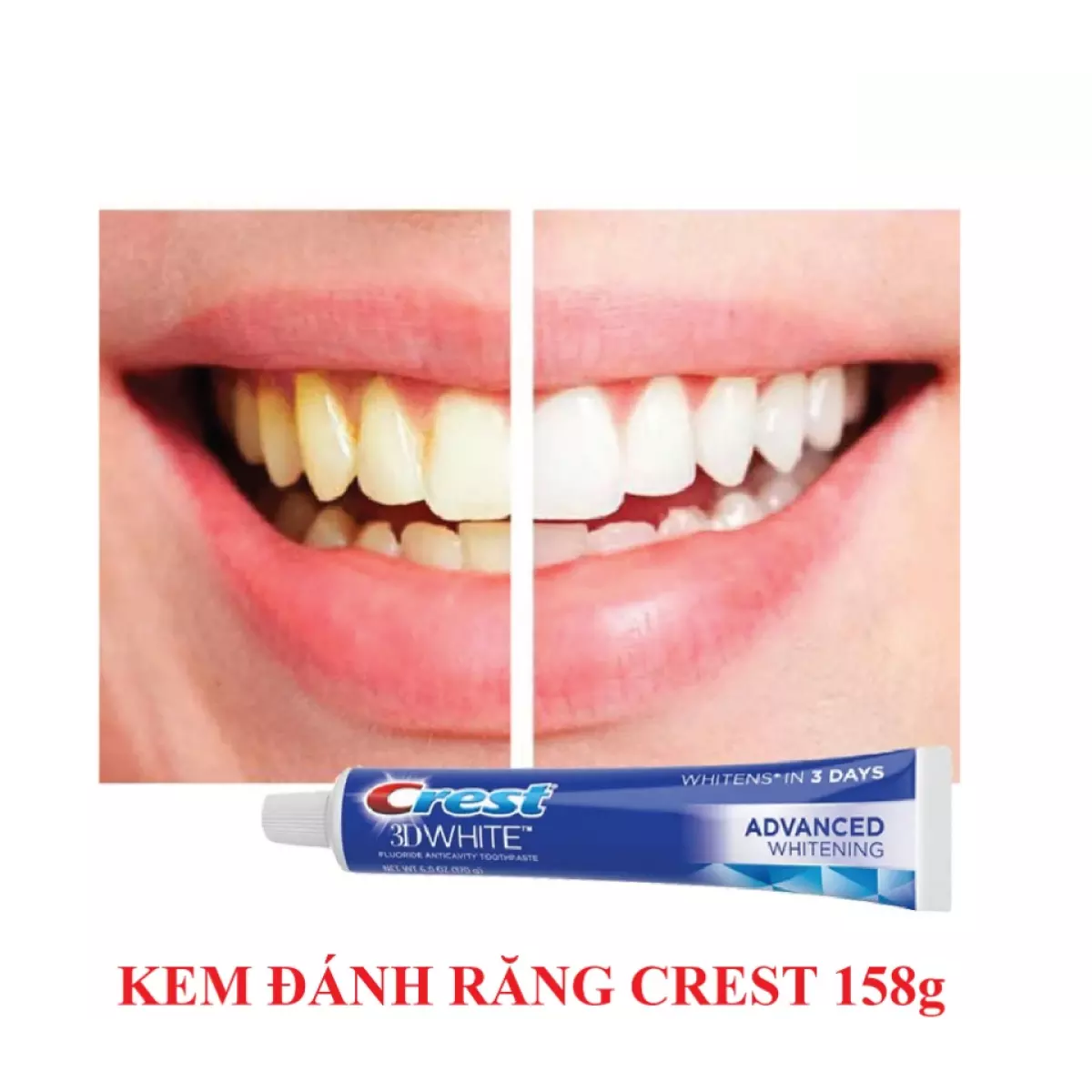 Lốc 5 Kem Đánh Răng Crest 3D White Advanced 147gr/tuýp