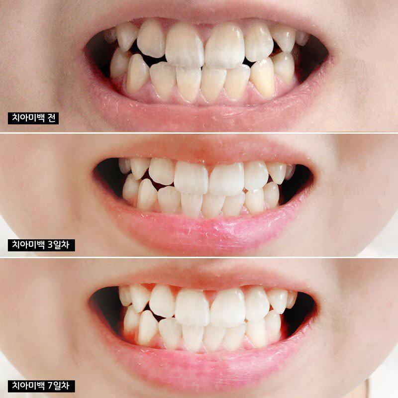 Kem đánh răng Giúp Trắng Răng, Chống Sưng Nướu Hương Chanh Median Dental IQ 93% 120g - Xanh Biển