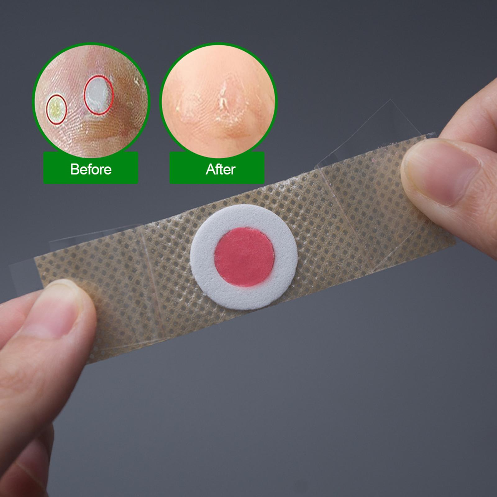 Cornside patch Ointment 42 tablets/box K04401