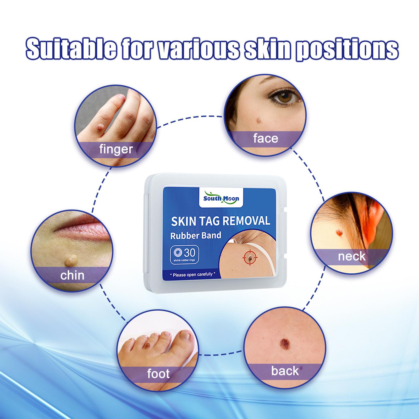 South Moon 30pcs/Box Mole Wart Remover Skin Tag Rubber Band Soften Keratin Painless Removal