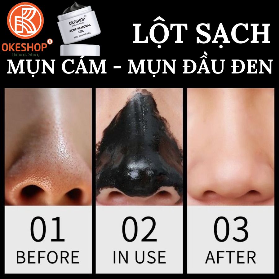 Gel Lột Mụn Than Tre Hoạt Tính OKESHOP 30ml - Giải Pháp Loại Bỏ Mụn Đầu Đen - Mụn Cám - Bạ Nhờn - Làm Sạch Sâu Và Thu Nhỏ Lỗ Chân Lông