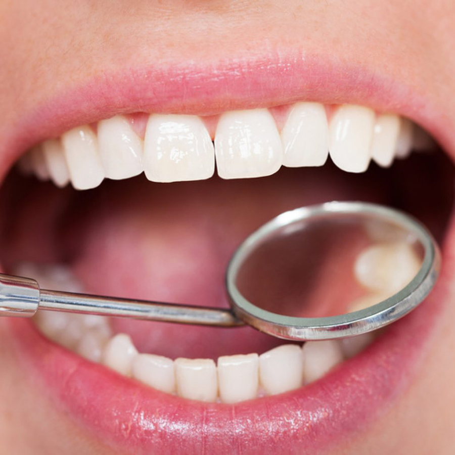 Hình ảnh Gói Trám Răng Bằng Composite Và Lấy Cao Răng – Nha Khoa Gia Hân