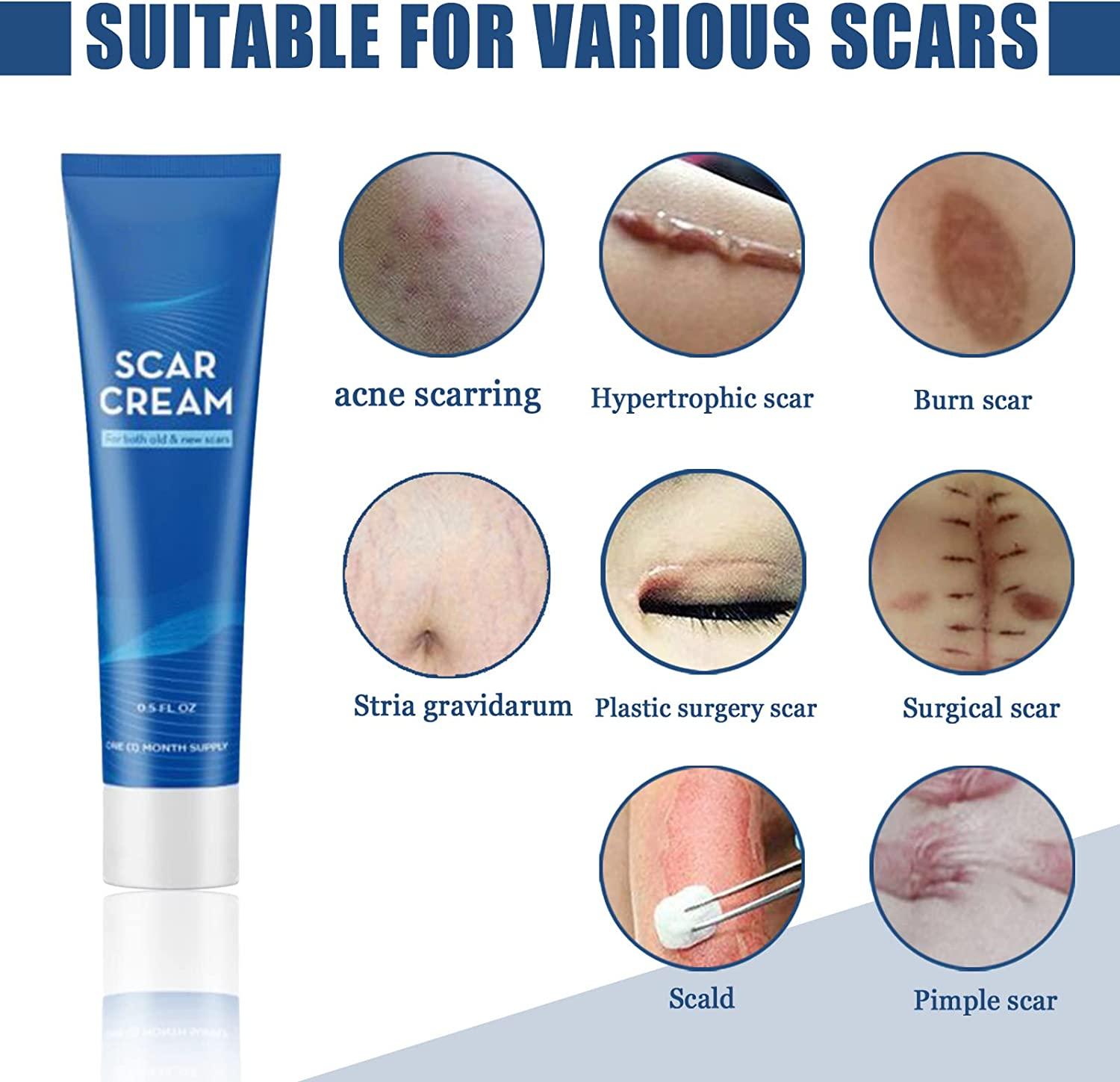 Scar Cream Scar Cream, Kem trị sẹo, Scar Gel Cream, Xóa vết rạn da, Vết rạn da, Mụn trứng cá