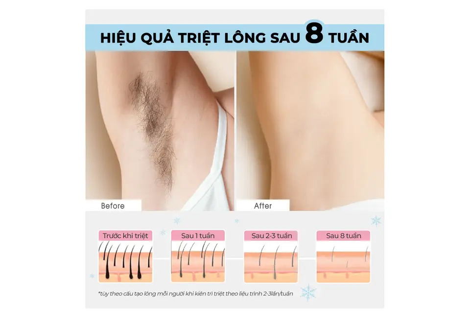 Máy Triệt Lông Lạnh Cá Nhân Halio IPL Cooling Hair Removal Device - Công nghệ triệt tận gốc nang lông - Đầu lạnh 10 độ C - Hàng chính hãng