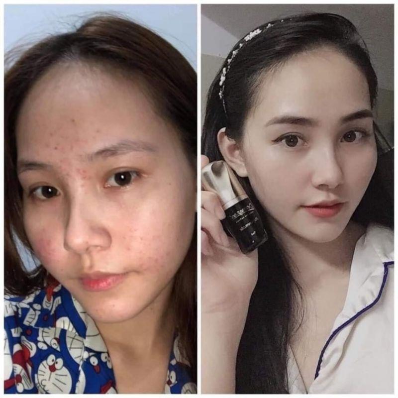 Bộ Tảo Trứng Cá Tuyết Dermapeel+ - 5 DERMAPEEL KẾT HỢP SERUM TRỨNG CÁ TUYẾT - SẠCH MỤN - DA CĂNG BÓNG TRẮNG SÁNG - HQ