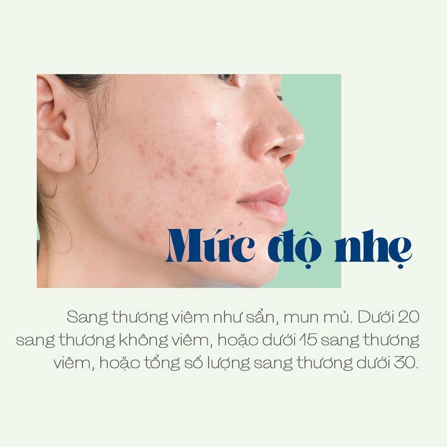 LIỆU TRÌNH CHĂM SÓC DA MỤN NẶNG NÂNG CAO