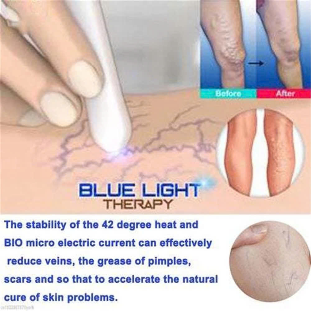 Máy LASER tẩy mụn và xóa sẹo với ánh sáng xanh thần kỳ: Giải pháp thông minh an toàn