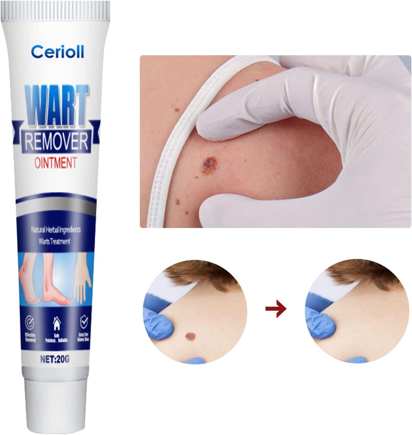 Mụn cóc, Chống mụn cóc ở chân, Không mụn cóc, góc, Chống mụn cóc ở tay/chân, Chống mụn cóc, Ngừng mụn cóc, Chống mụn cóc, Chăm sóc mụn cóc/ngô/chân