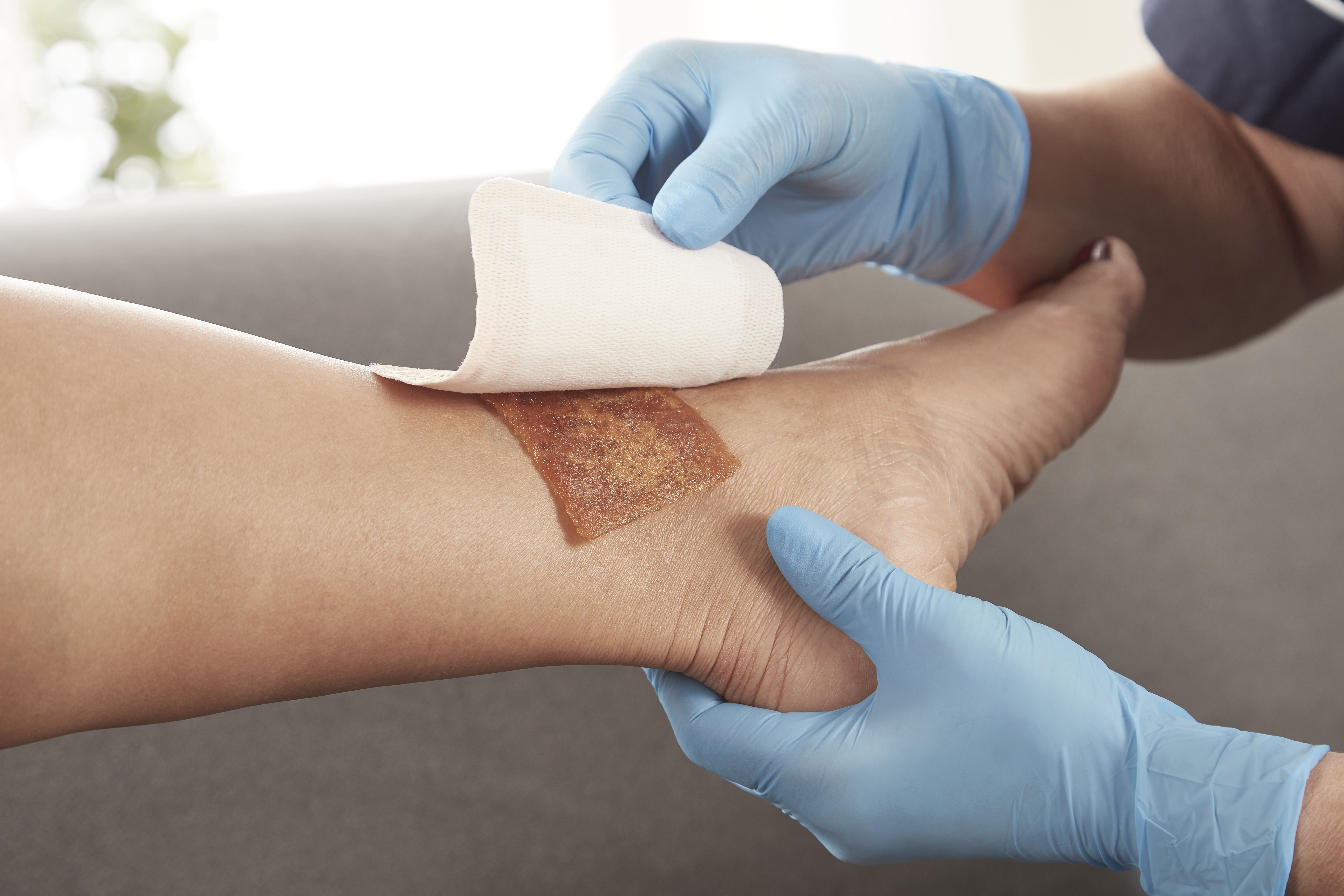 Gạc tẩm mật ong Manuka chăm sóc vết thương nhiễm khuẩn - Algivon