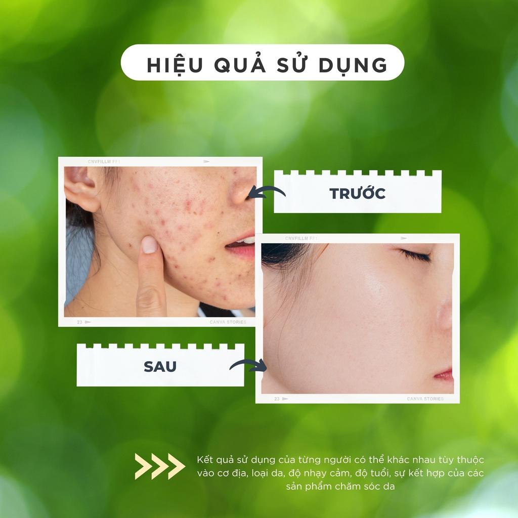 Kem mờ giảm mụn thâm siêu tốc CHAMIS