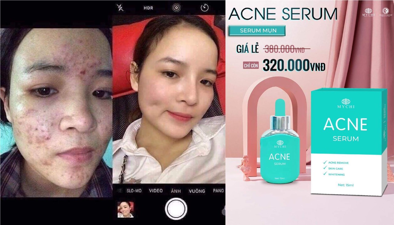 Serum mụn ACNE Mychi