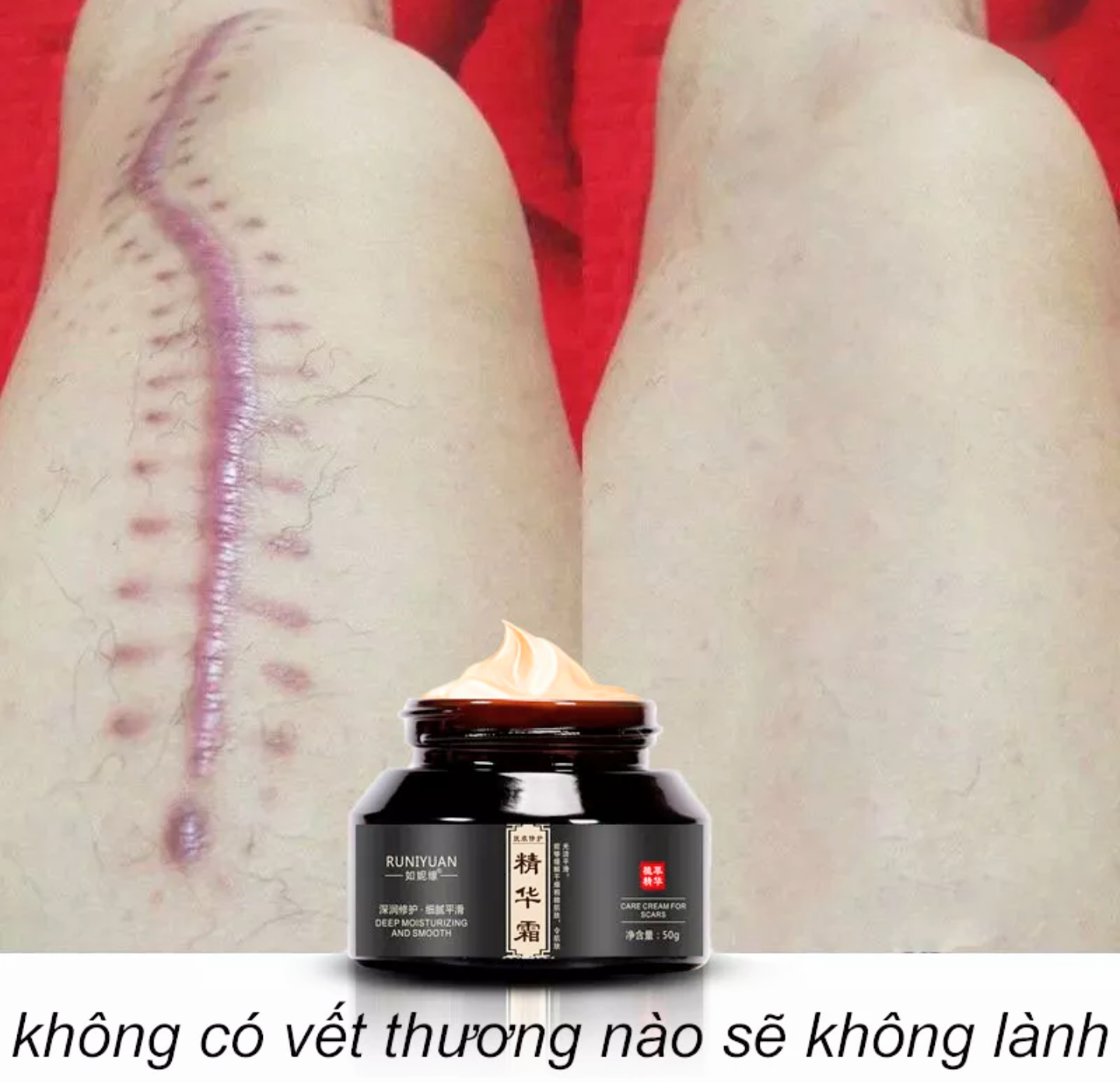 KEM TRỊ XÓA LÀM MỜ CÁC VẾT SẸO TRÊN DA HOÀN TOÀN NHANH CHÓNG HIỆU QUẢ CAO LOẠI TỐT NHẤT HIỆN NAY