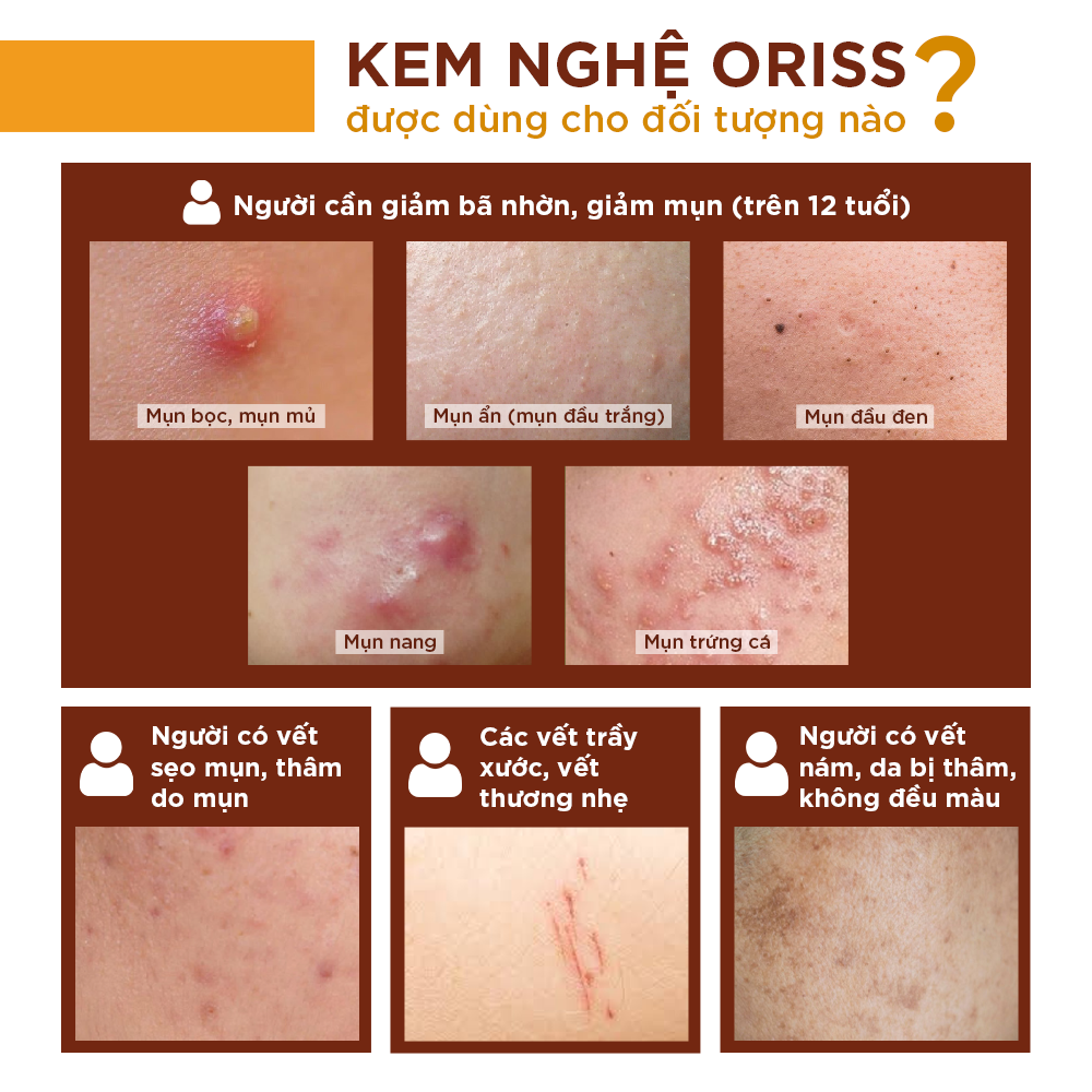 Kem Nghệ Giảm Mụn Mờ Thâm Liền Sẹo Kích Thích Tái Tạo Da Oriss Tuýp 20g