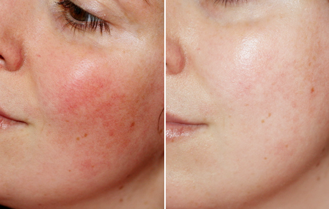 Kem dưỡng phục hồi Teoxane Deep Repair Balm