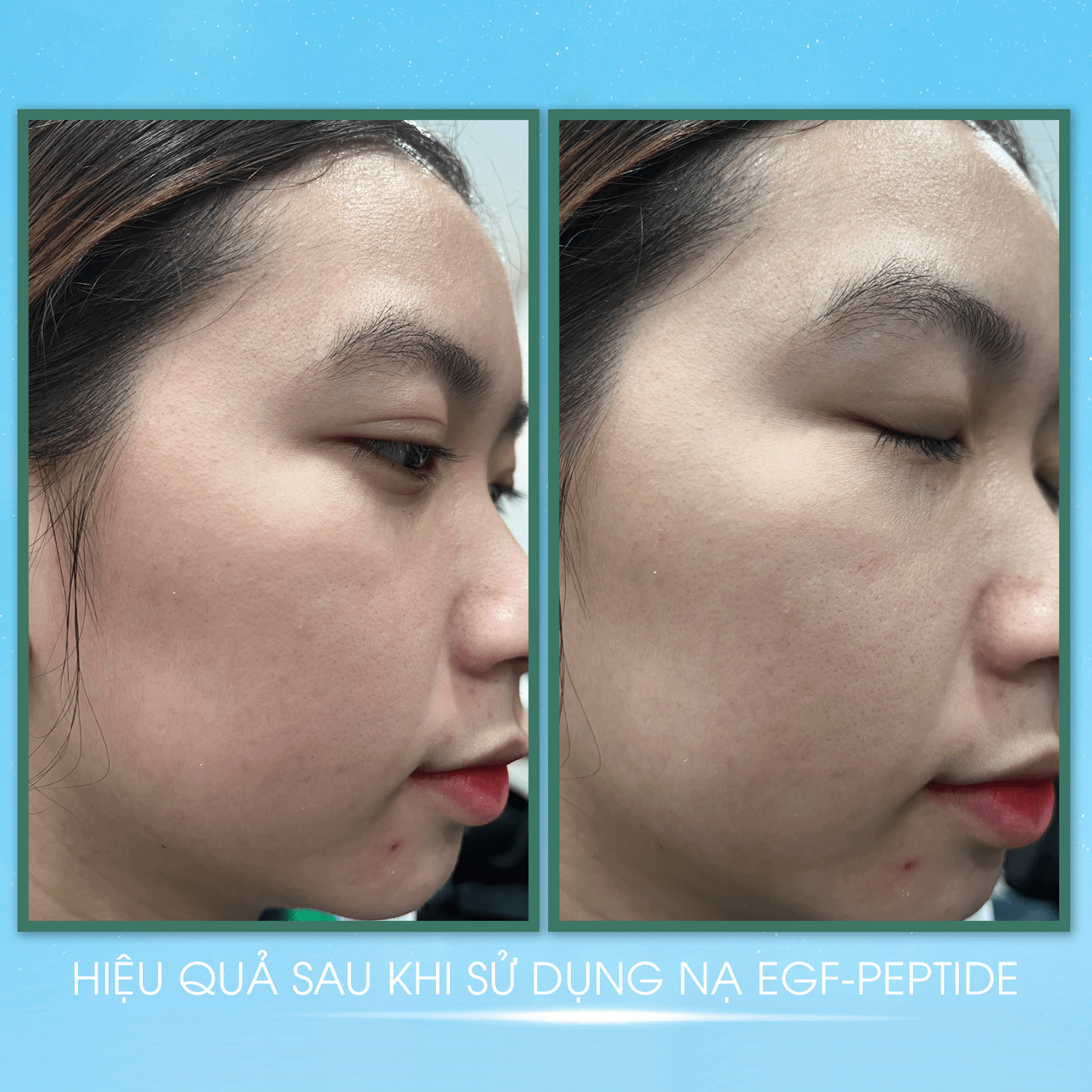 COMBO 10 Mặt Nạ Dạng Thạch MS EGF - Peptide Mask Giúp Dưỡng Ẩm, Mặt Nạ Thạch Phục Hồi Và Tái Tạo Da Giúp Da Săn Chắc (1 Miếng - 23g) - MỸ PHẨM MS COSMETIC