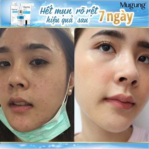 Serum Hoặc sửa rửa mặt giảm mụn Mugung 7 ngày hiệu quả giảm mụn đầu đen,mụn bọc (Làm xẹp không bong da) Acne Treatment