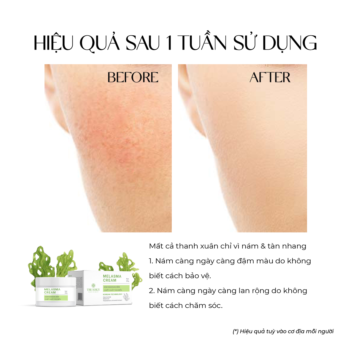 Kem nám và tàn nhang ban đêm Truesky Melasma Cream chiết xuất tảo biển 20g