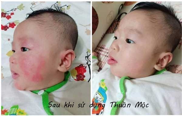 Dùng Kem bôi da Thuần Mộc trị chàm sữa