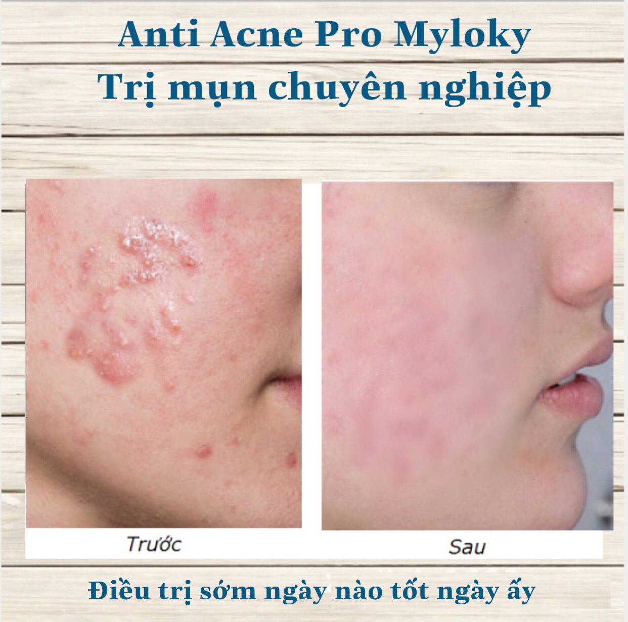 SERUM HỖ TRỢ TRỊ MỤN NHANH 99,9%. NGĂN NGỪA TÁI PHÁT,ANTI ACNES PRO MYLOKY