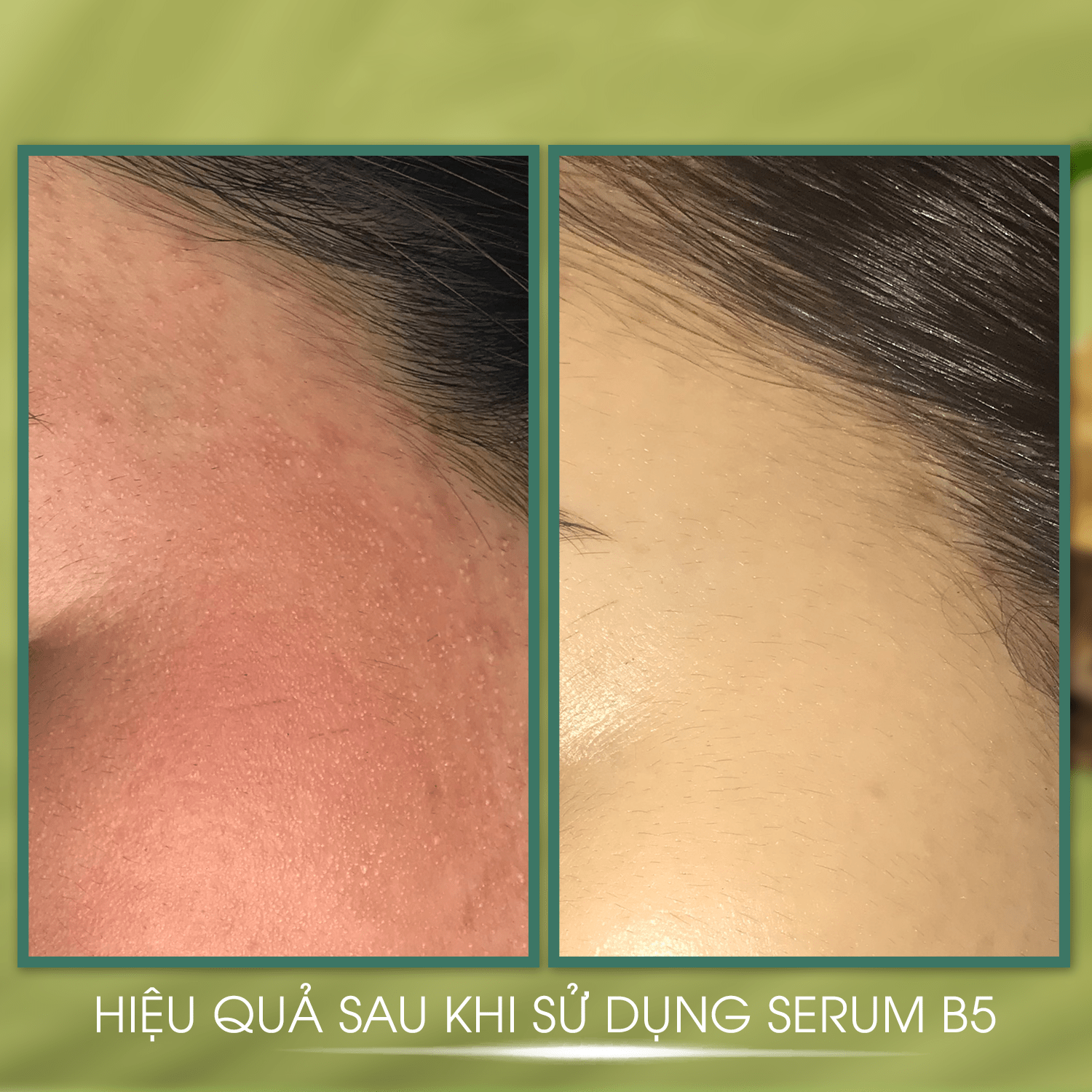 Serum Phục Hồi Da Hyaluronic Acid + Vitamin B5 - JOA GREEN 30ml, Serum B5 Tái Tạo Da Và Chống Lão Hoá - Mỹ Phẩm MS COSMETIC