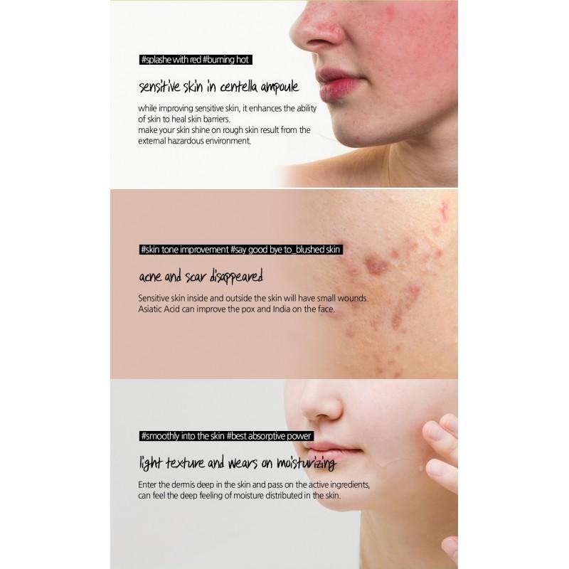 Bộ 5 SP Giảm Mụn, Làm Dịu Da Skin1004 Madagascar Centella
