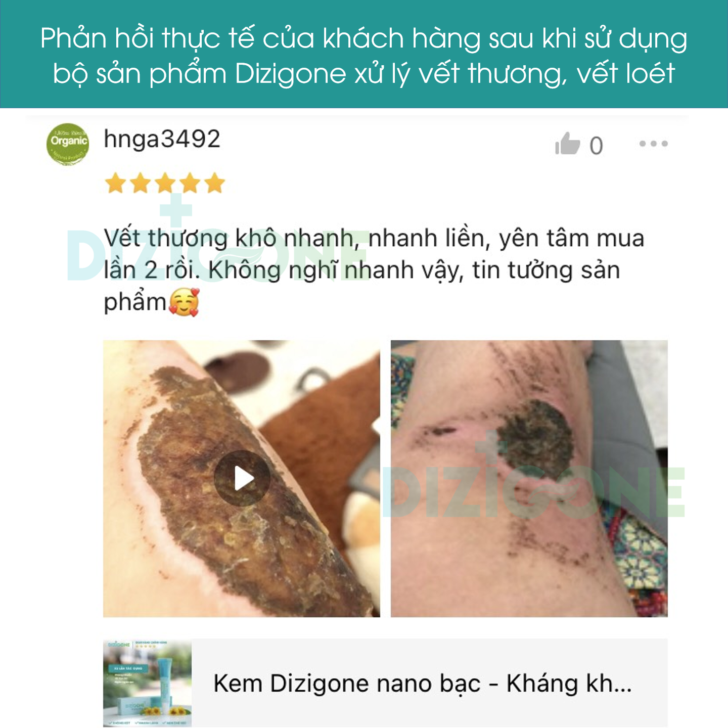 Dung dịch kháng khuẩn DIZIGONE chăm sóc tổn thương lành nhanh, không đau xót, tái tạo da, ngăn ngừa sẹo 300ml