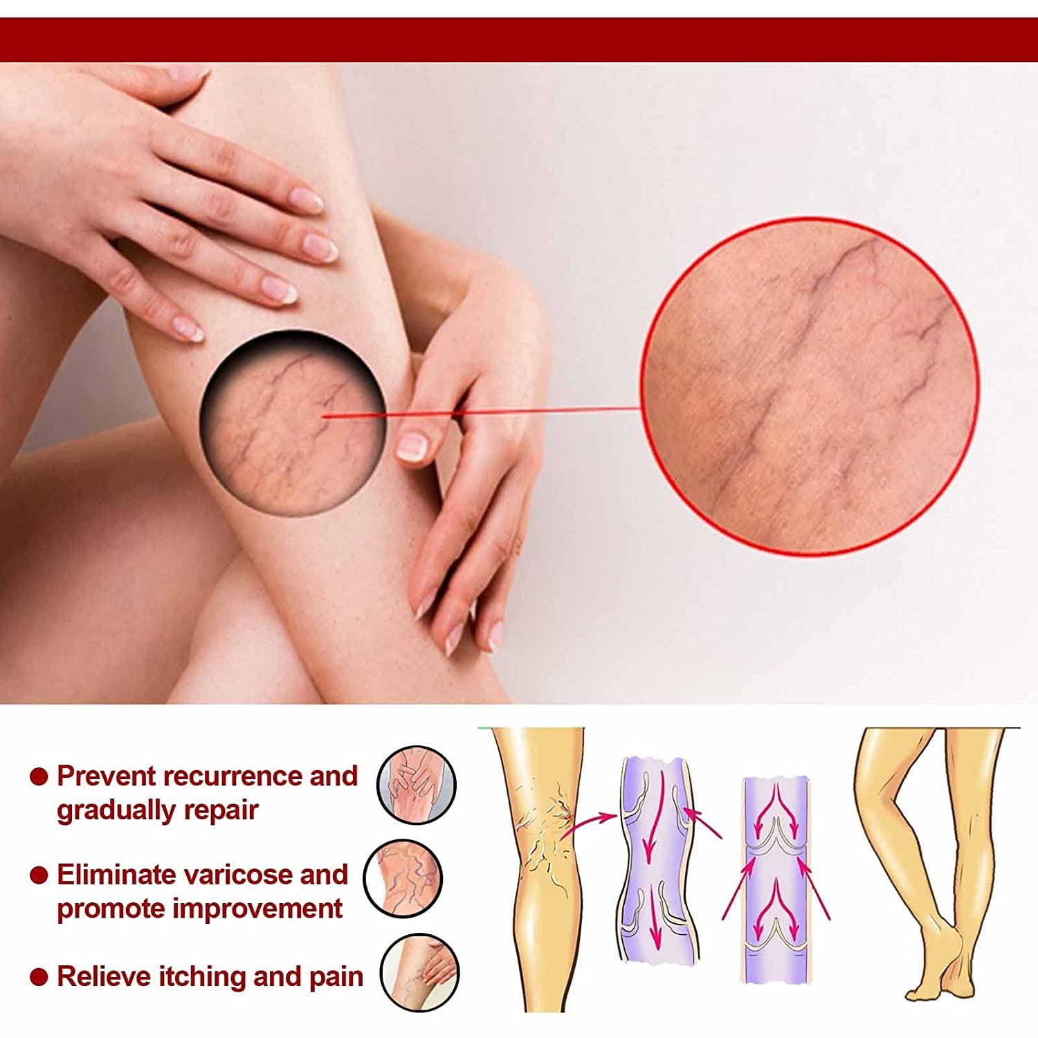 Kem tĩnh mạch tĩnh mạch, kem tĩnh mạch tĩnh mạch so với tĩnh mạch nhện, kem tĩnh mạch tĩnh mạch so với tĩnh mạch nhện, thuốc mỡ chăm sóc chân, 20G