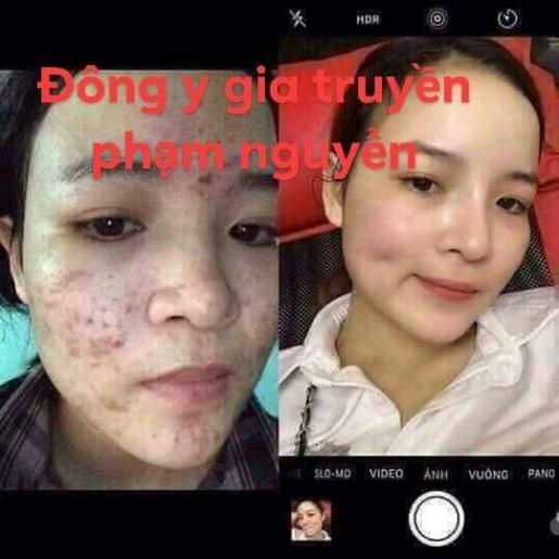 Bộ kem dưỡng trăng, giảm nám tàn nhang và serum cốt sâm đông y gia truyền phạm nguyễn