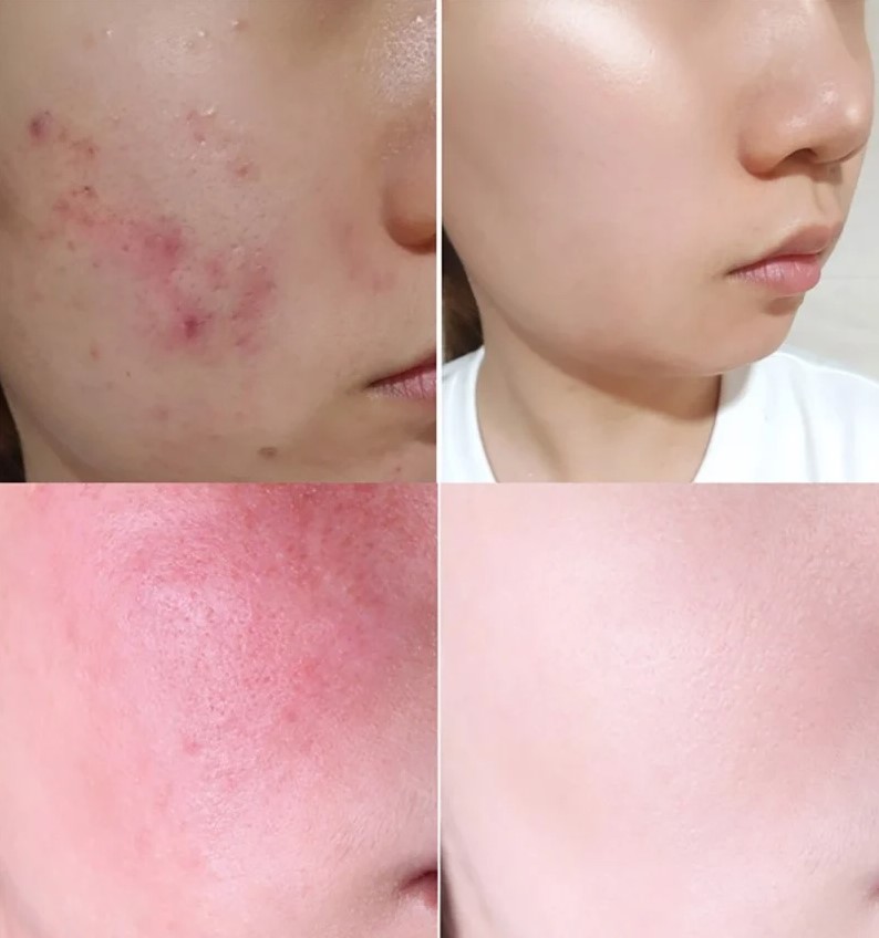 Kem Dưỡng Ẩm, Phục Hồi, Giảm Mụn Chiết Xuất Ốc Sên, Tràm Trà, AHA-BHA-PHA 30 Days Some By Mi Cream