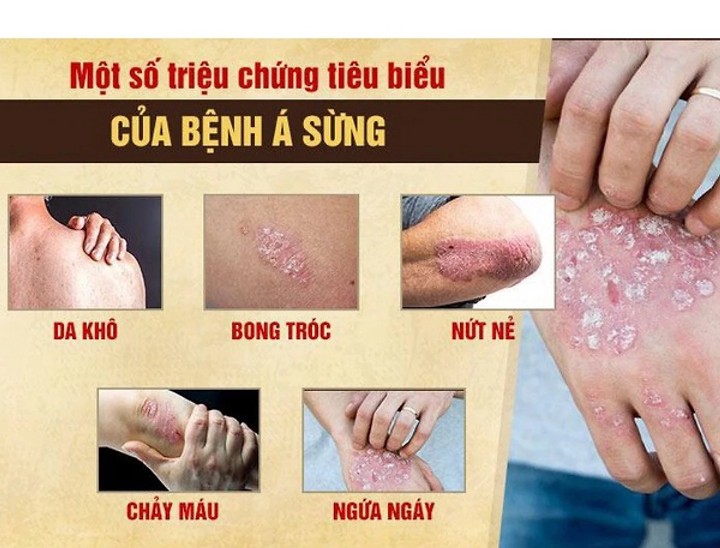 KEM BÔI DA LIỄU ĐÔNG Y-Nấm ngứa, tổ đỉa, hắc lào, lang men, vẩy nến, á sừng, zona các vấn đề về da