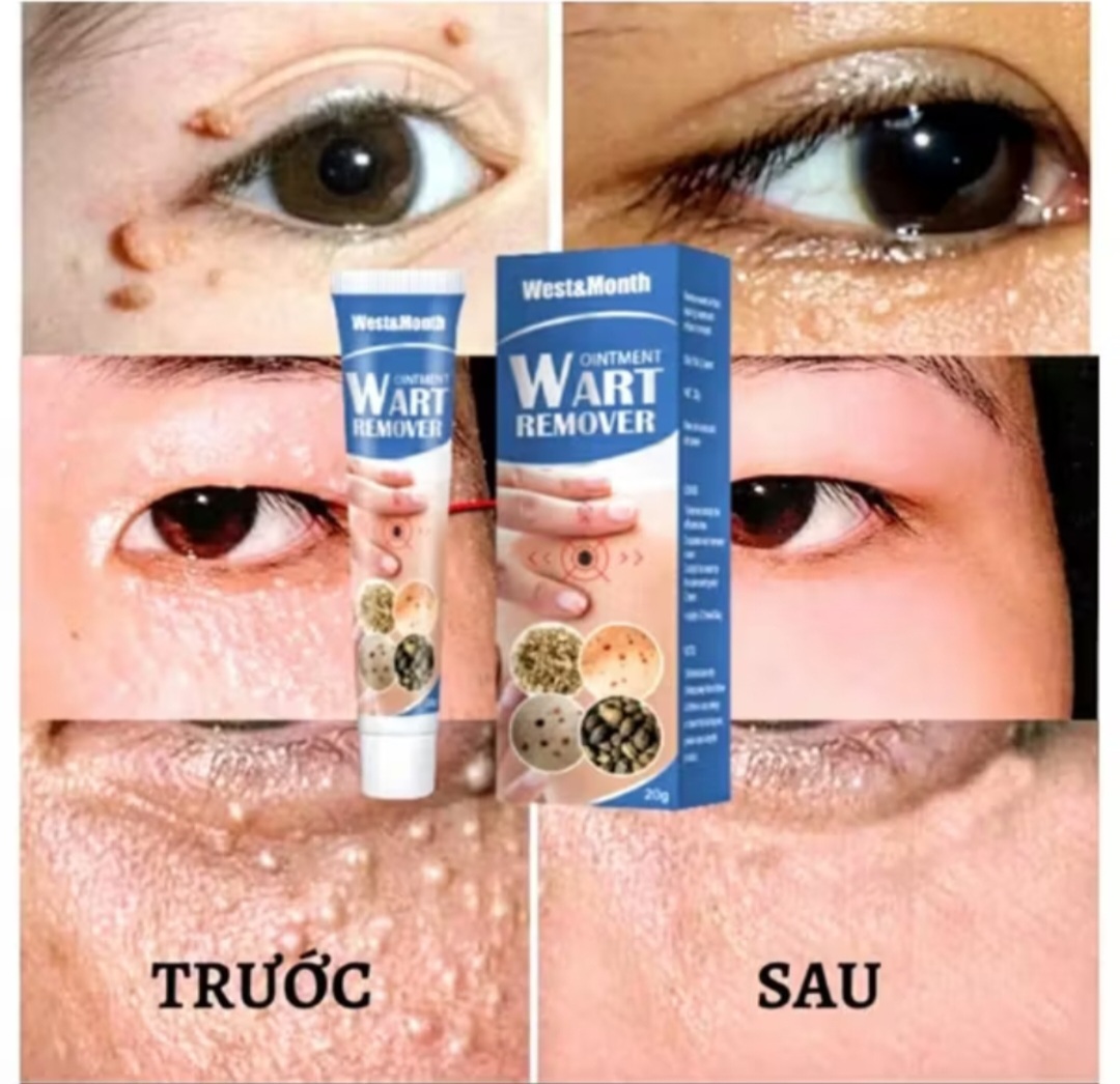 HỘP KEM BÔI TRỊ HẾT MỤN CÓC NÚT RUỒI MỤN THỊT HÀNG CHUẨN