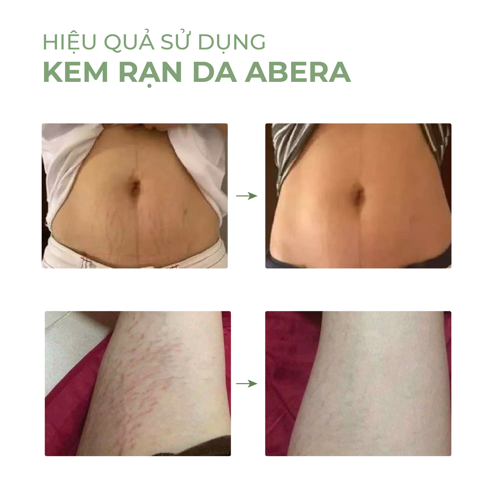 [COMBO 3] Kem Rạn Da Ovela Abera 50ML - Dưỡng Ẩm,  Giảm Rạn Cũ, Ngừa Rạn Mới, Kem Rạn Da Cho Mẹ Bầu
