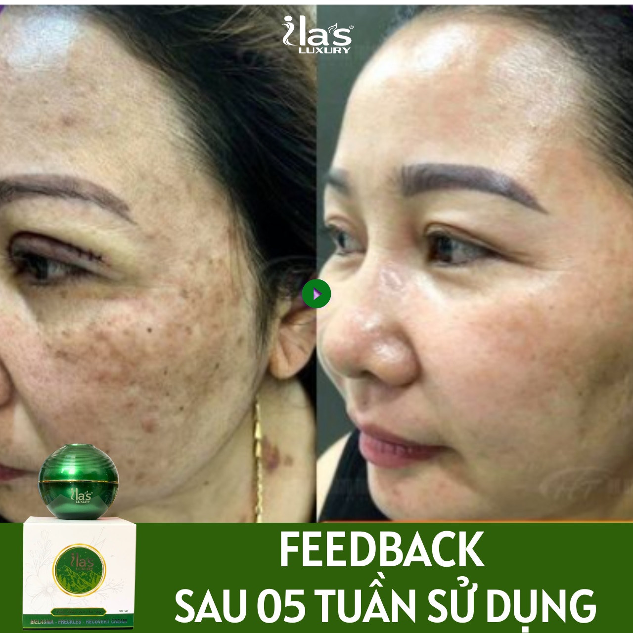 KEM HỖ TRỢ ĐIỀU TRỊ NÁM SẠM - TÀN NHANG – GIÚP PHỤC HỒI DA - TRẮNG SÁNG DA ILA'S LUXURY CHÍNH HÃNG 16G