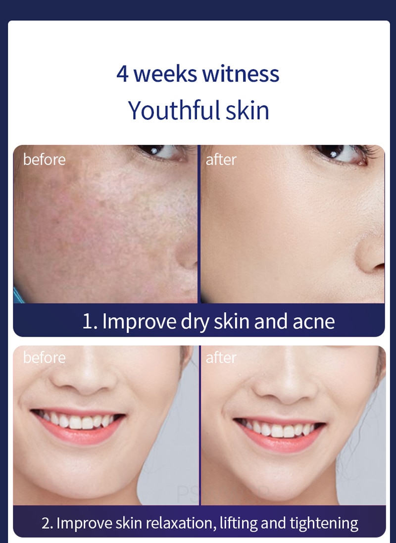 Dụng Cụ Massage Cầm Tay Nâng Cơ Mặt Làm Trẻ Hóa Da Bloom 5 Skin Tightening Tech - 15 phút mỗi ngày sẽ hiệu quả