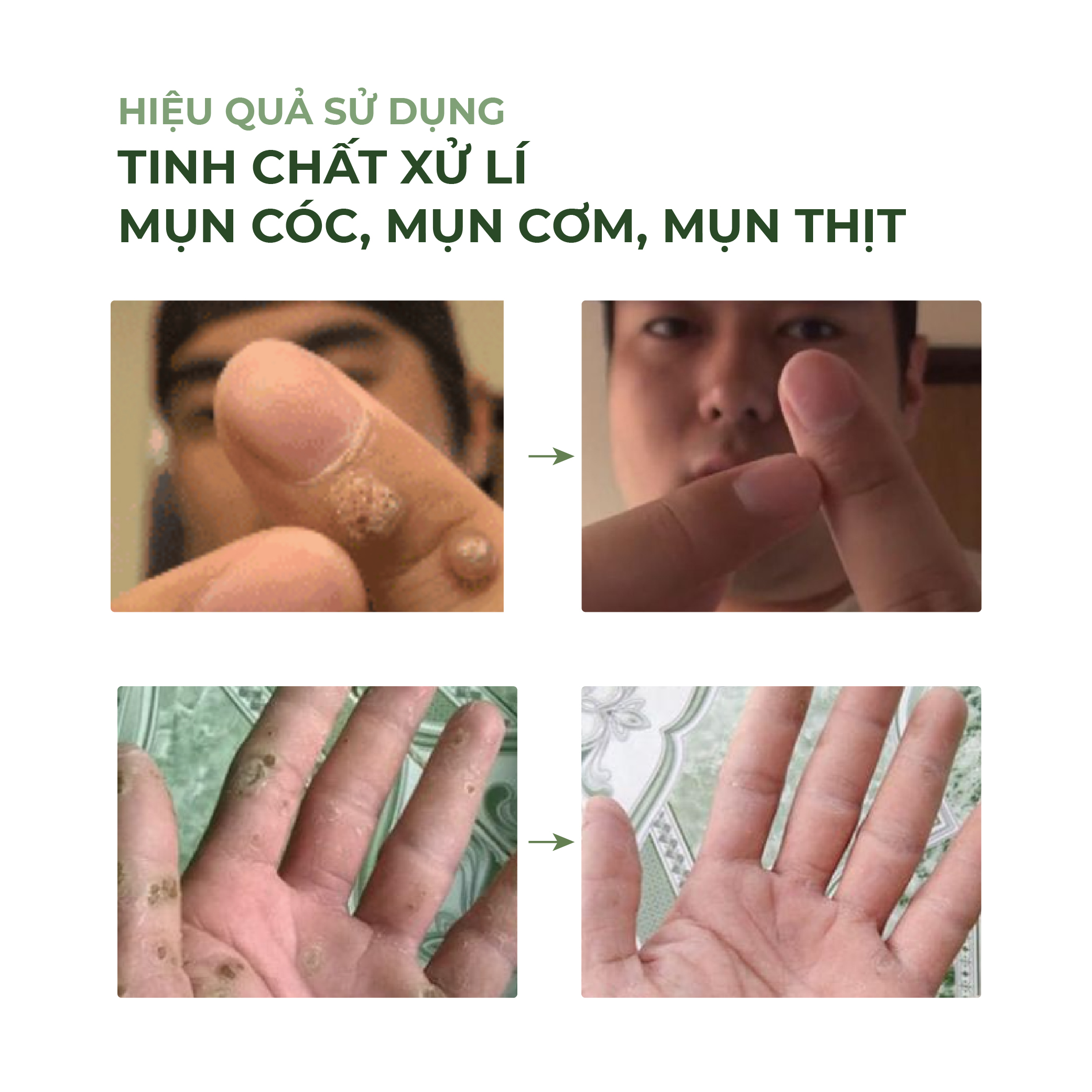 Tinh chất Đu Đủ PAPAYA ABERA 7ml Xử Lý Mụn Cóc, Mụn Cơm, Mụn Thịt Sau 7 Ngày