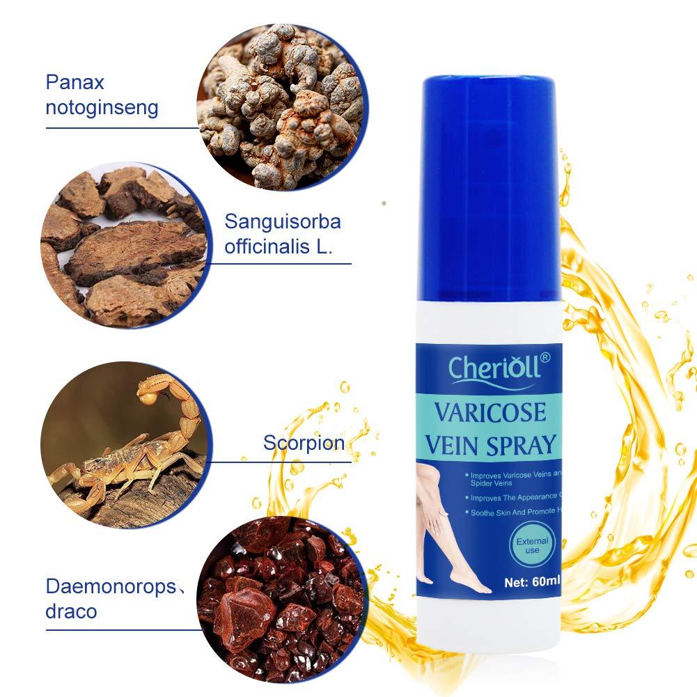 Tĩnh mạch giãn tĩnh mạch, phun tĩnh mạch tĩnh mạch, kem tĩnh mạch tĩnh mạch, kem so với tĩnh mạch nhện, tĩnh mạch giãn tĩnh mạch, kem nhện, tĩnh mạch nhện, chăm sóc chân an toàn