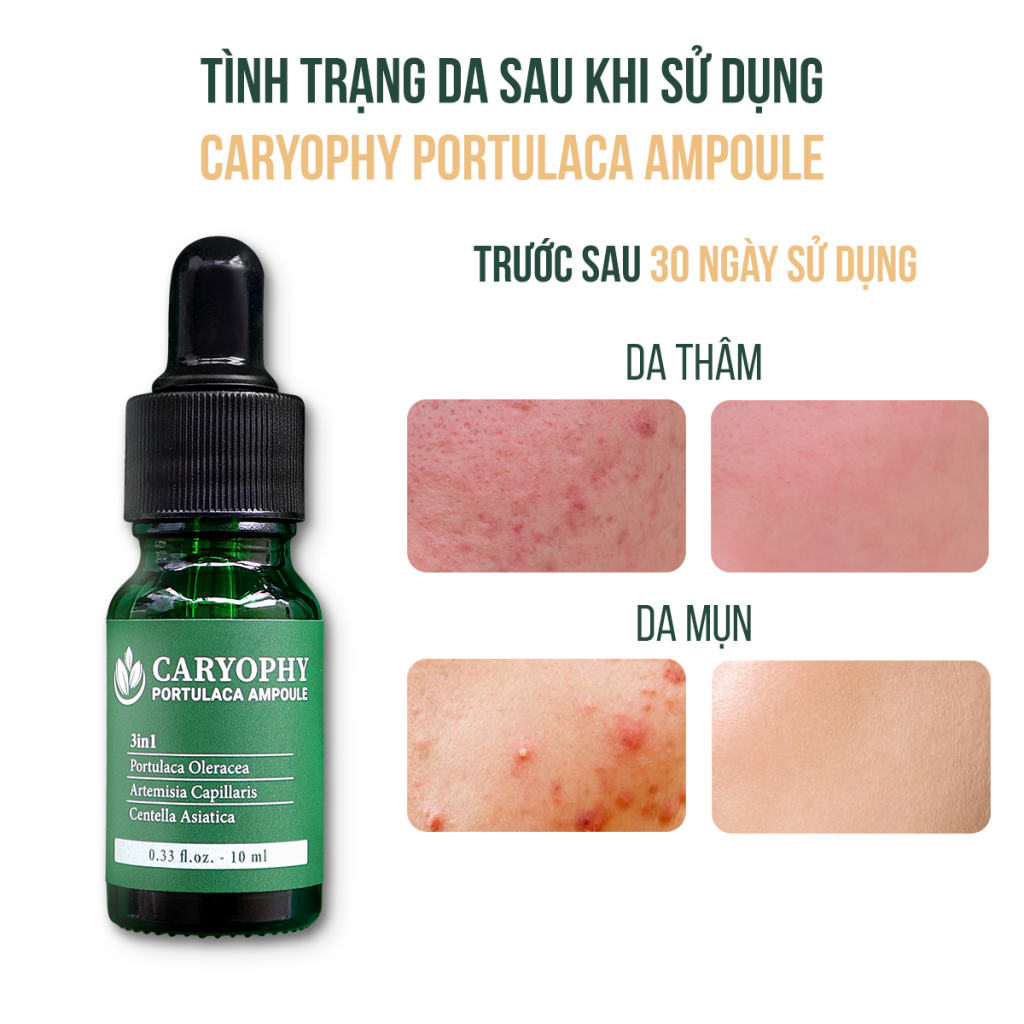 Tinh chất giảm và ngăn ngừa mụn 3 trong 1 Caryophy Portucala Ampoule 10ml