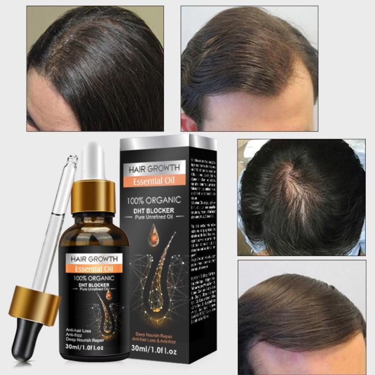 Tinh dầu gừng chăm sóc tóc chắc khỏe Hair Growth Essential Oil 30ml