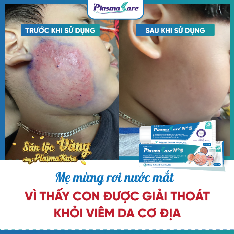 Kem bôi da Nano bạc cho viêm da cơ địa, viêm da tiếp xúc, muỗi và côn trùng đốt Plasmakare No5